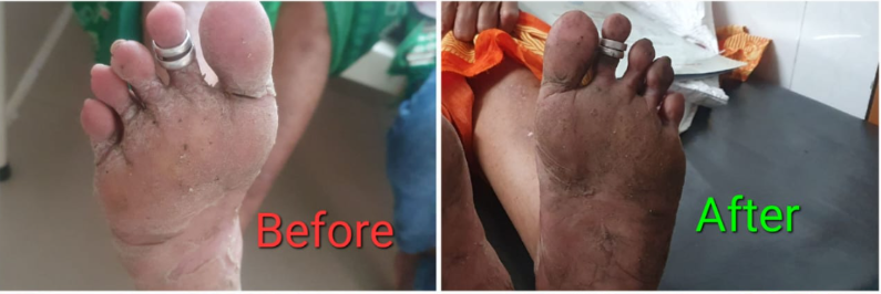 Before and After Skin Treatment